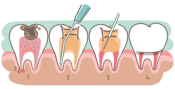Tratament endodontic
